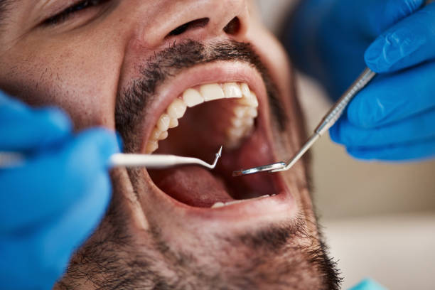 Full Mouth Reconstruction in Selma, TX